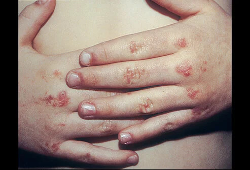 Dermatomyositis